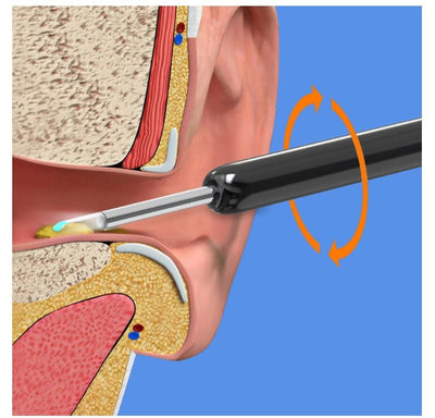 Earwax Removal Kit