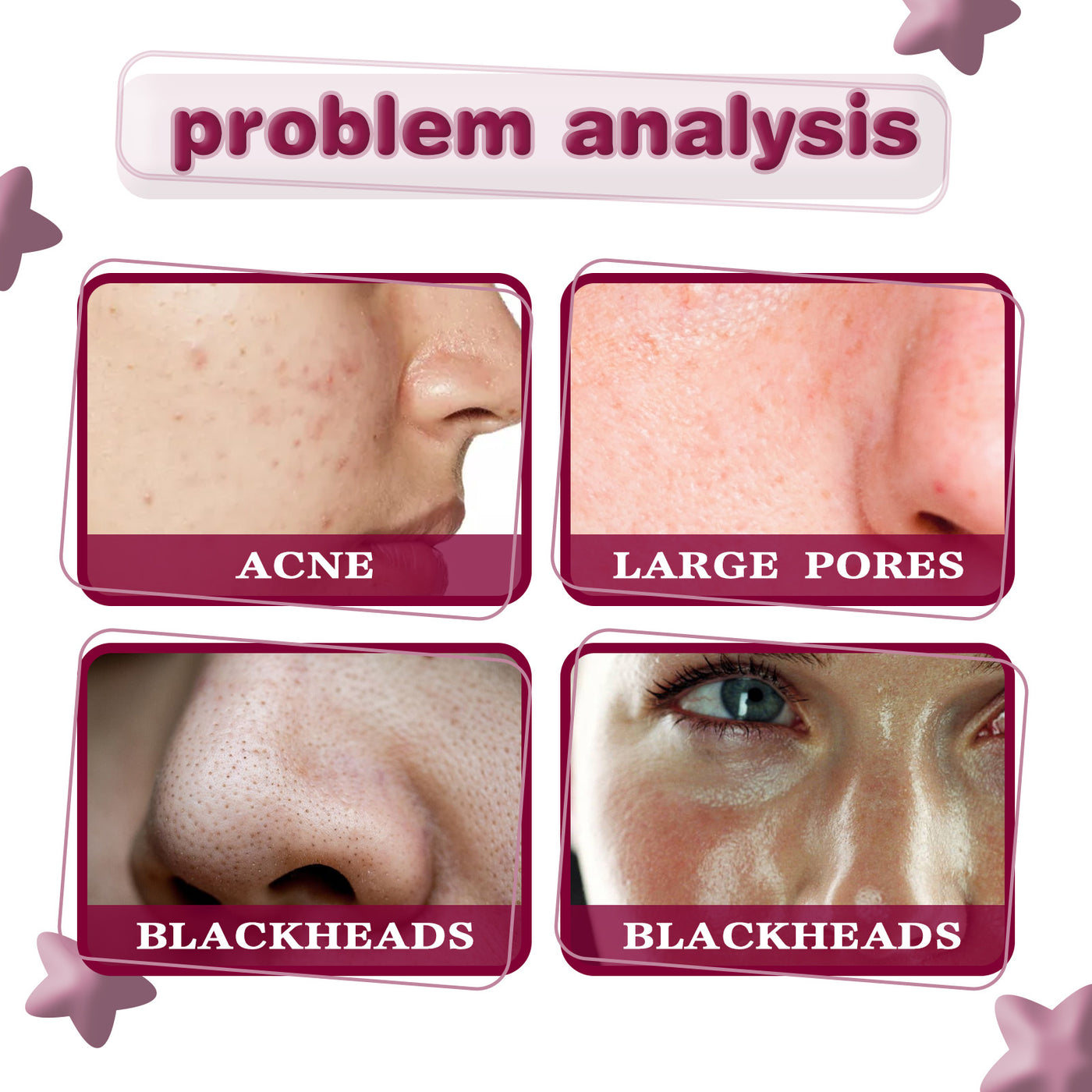 Tartaric Acid Blackhead Removing Acne Smallpox Diluting Brightening