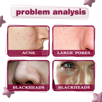 Tartaric Acid Blackhead Removing Acne Smallpox Diluting Brightening